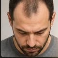Crema Alopecia Crecimiento Cabello Garantizado Entrega Ya