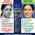 Crema Para Eliminar Verrugas - imagen 4
