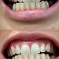 Cepillo eléctrico limpiador de poros faciales con puntos negros 4 cabezales